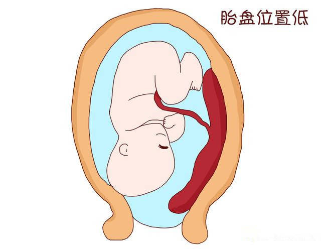 胎儿着床位置低危险吗?对胎母儿有什么影响?