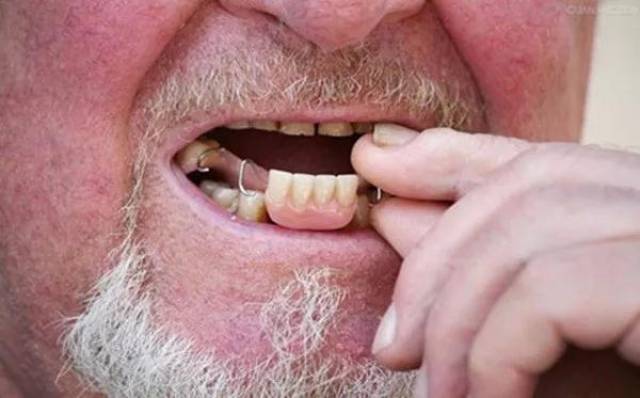 假牙能够用多久?99%的人都不知道!