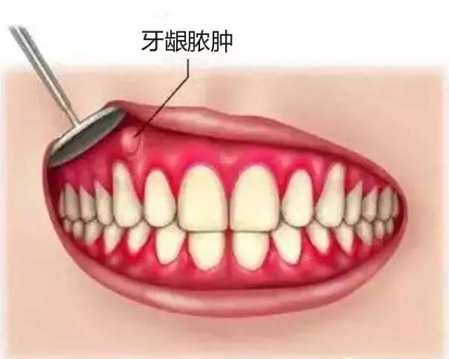 生活中发现牙齿周围的牙龈出现脓包或肉芽的现象并不少见,尤其是儿童