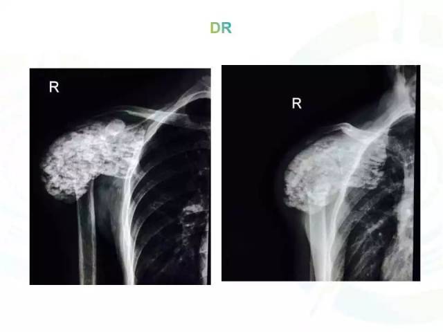 【每日一例| 580例】肿瘤样钙质沉着症