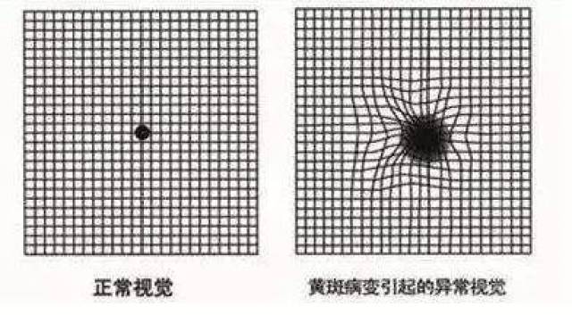 一只眼看门框,自查黄斑!