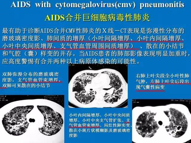 肺部炎症的影像学汇总