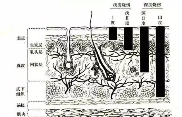 临床医考,烧伤面积计算口诀