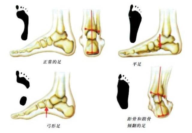 成语平足什么_平足是什么样子图片