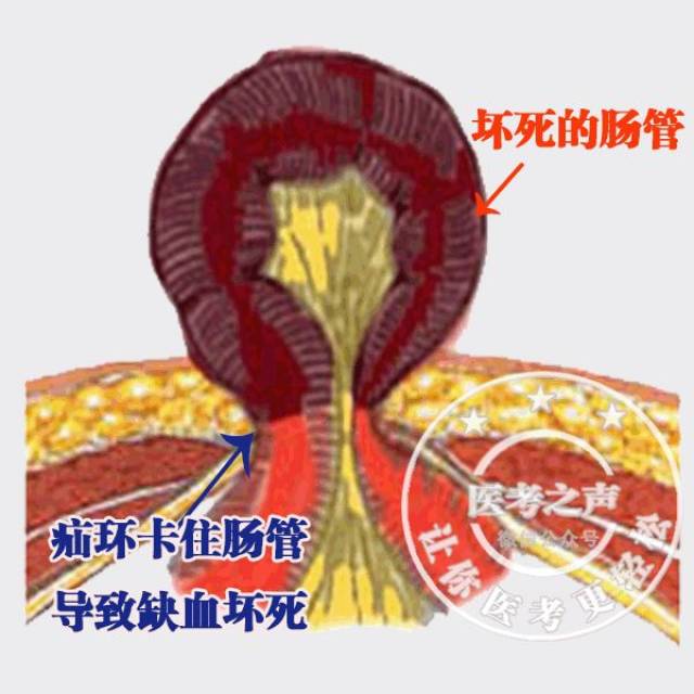 所以迎来的是一顿暴揍 如果嵌顿疝不能及时解除 狭小的洞口压迫肠管
