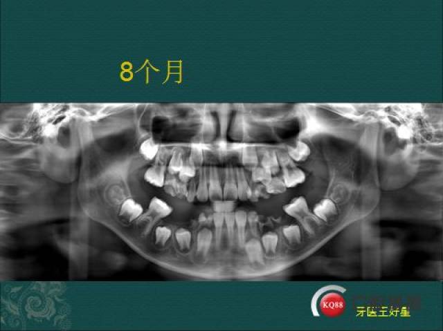 下颌采用义齿间隙保持器保持间 牙进中移动,同时