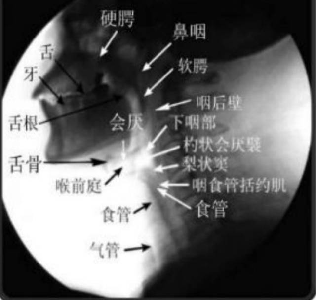 【愈风天使】卒中后吞咽障碍