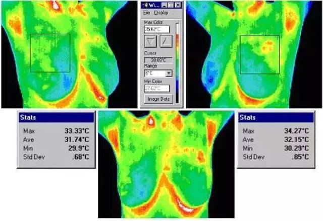 安吉丽娜切除乳腺:红外诊断热成像技术呵护女性健康