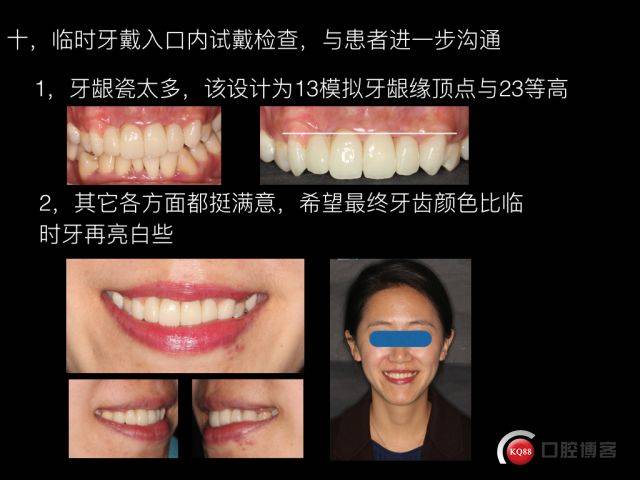 爱迪特绚彩的完美呈现美学修复设计引导的前牙美学修复