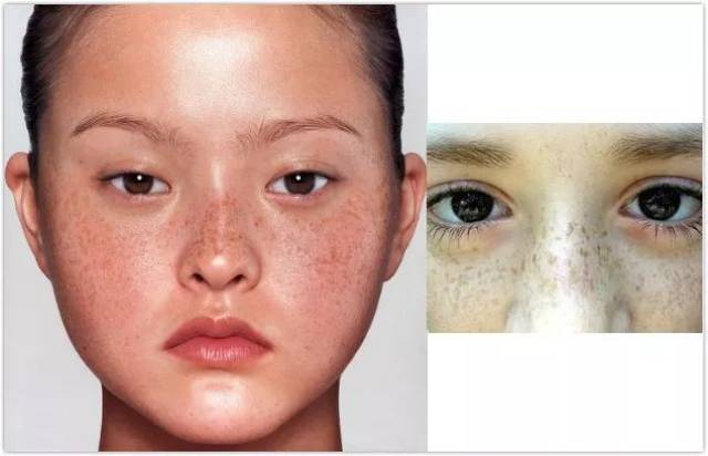 雀斑比较可怕,因为它有 遗传性,但是咱们亚洲人是黄皮肤,遗传的可能性