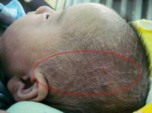 皮肤科医生:宝宝祛乳痂千万别用手抠!试试这2个方法,安全可靠!