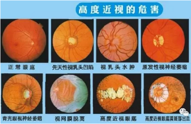 假性近视逐步发展为近视再到高度近视,高度近视会引起视网膜脱落及