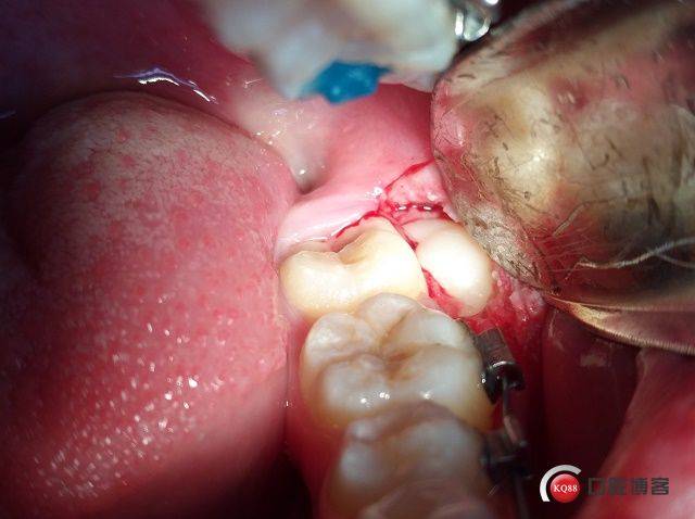 Ⅲ类低位近中颊侧水平埋伏阻生拔除术