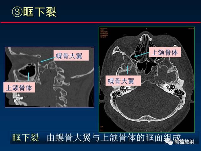 颅底重要ct解剖及其临床意义