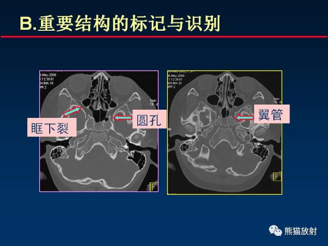 颅底重要ct解剖及其临床意义