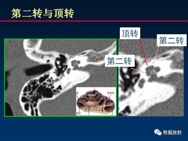 颅底重要ct解剖及其临床意义