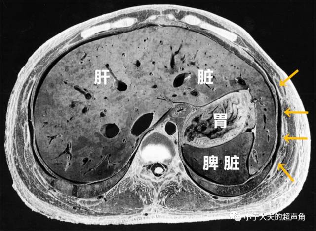 光从单张超声或ct图像上,我们很容易认为"獭尾肝"是肝左叶伸向脾脏的