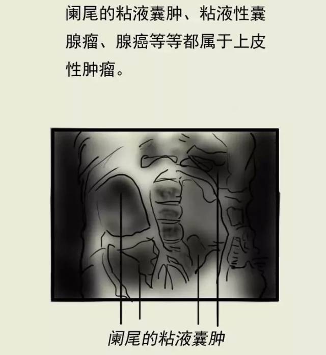 还有这种病哈尔滨大妈忍痛几十年,阑尾炎竟恶化成这种癌,吓人!