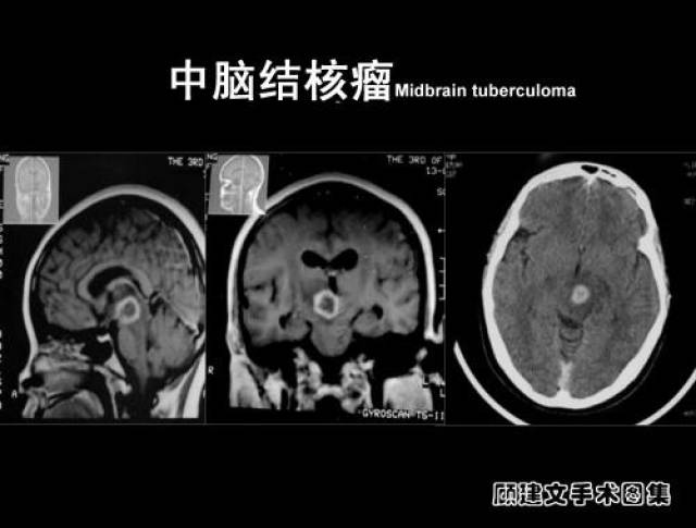 中脑结核瘤的手术诊断