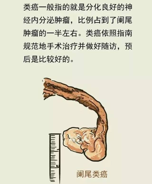 正常的阑尾只有大约小手指头粗细,而赵阿姨的烂尾肿得如同鸡蛋大小.