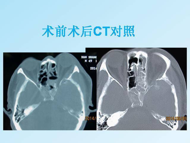 视神经管骨折失明减压术