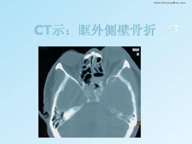 视神经管骨折失明减压术