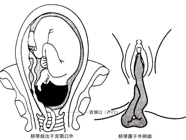 脐带脱垂,生死一线之时,产科医生上演了一场惊心动魄的救治