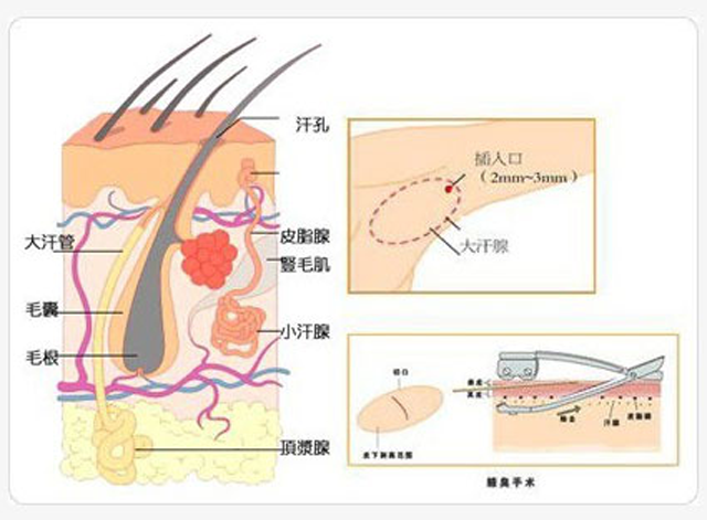 其长度在2-3cm之间,可在直视下完成大汗腺的切除,术后可将切口隐藏于