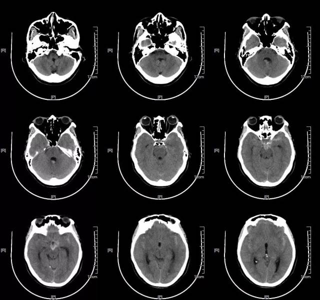 患者入院后头颅ct提示蛛网膜下腔出血,以脑干前方为主,提示后循环