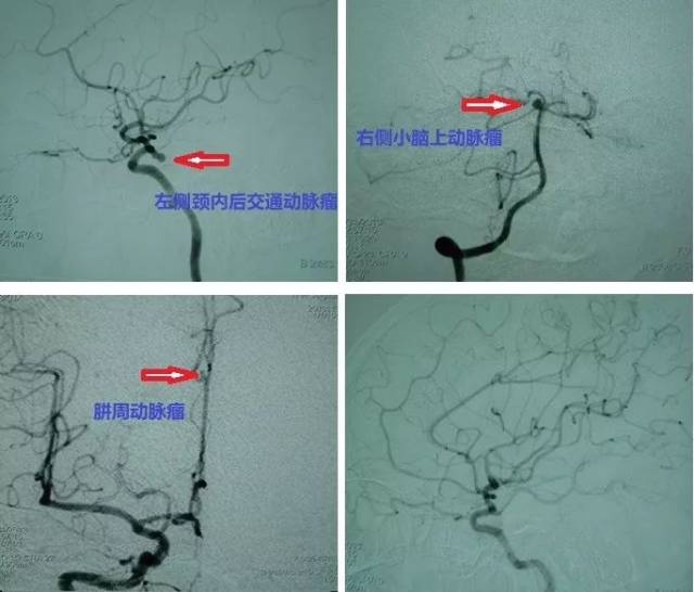 外院头颅dsa结果提示颅内多发动脉瘤:分别为左侧颈内后交通动脉瘤