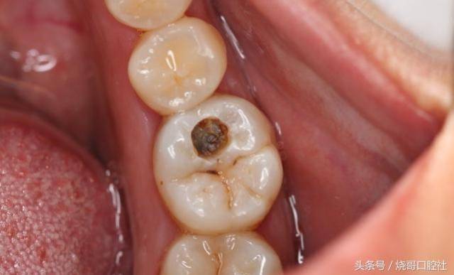 为什么补过的牙齿那么容易坏?
