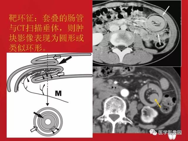 肠套叠的ct诊断