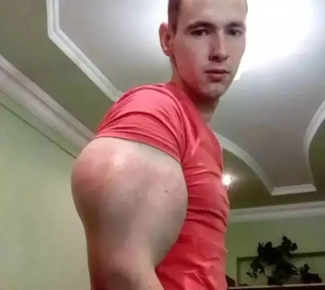 俄罗斯男子梦想变大力水手,手臂粗60cm,快要爆炸