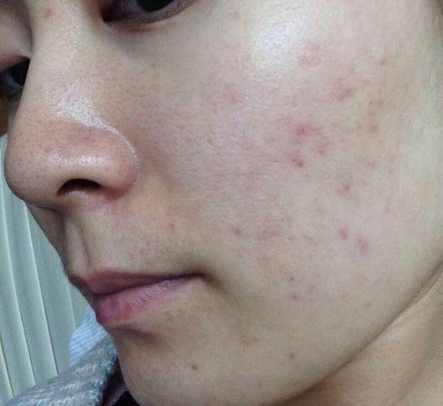 女生脸上毛孔粗大怎么办?
