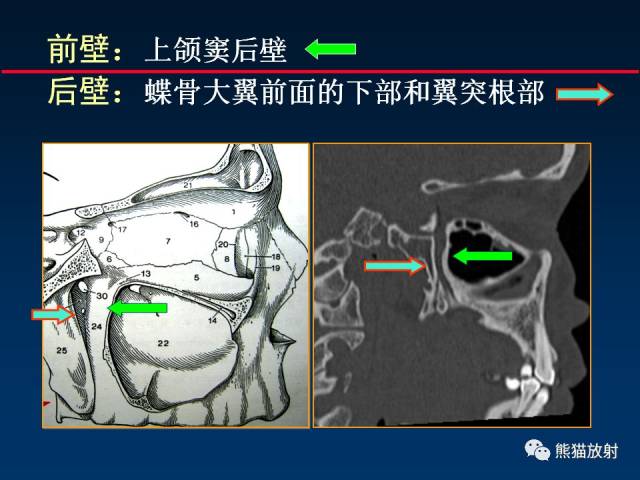 【柳澄讲坛】颅底重要ct解剖及其临床意义