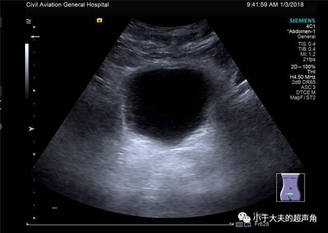 超声提示: 膀胱上方囊实性混合回声,包裹性积液?其它?