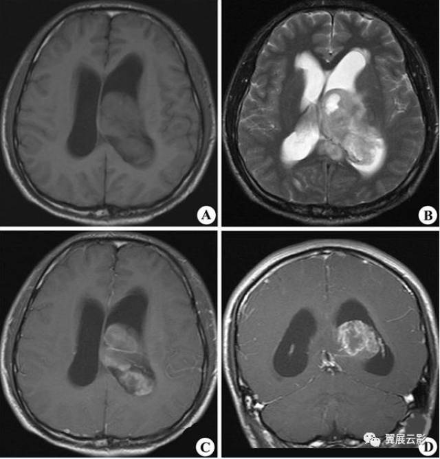 室管膜瘤:源于脑实质或源于侧脑室而突入脑实质的室管膜瘤呈分叶状
