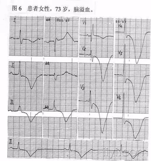 ecg:广泛,弥漫的st段弓背抬高,伴有宽大,深倒的t波.