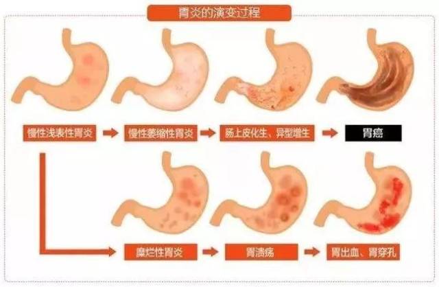图片解说什么是胃黏膜肠化?肠化的危害和怎样