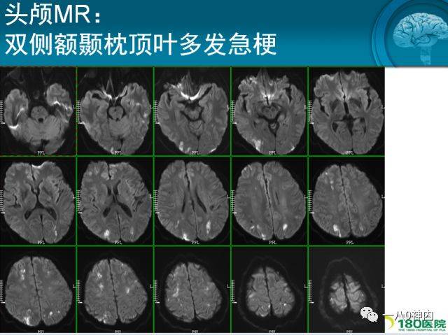 旋风杀手:表现为急性脑梗死的无痛性主动脉夹层