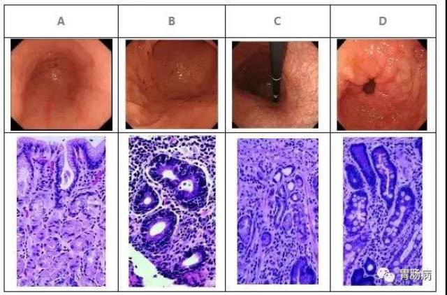 请看下图,胃镜及活检病理的图片:肠上皮化生指的是正常的胃粘膜上皮被