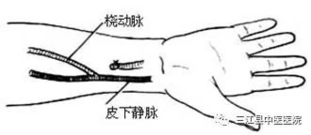 三江县中医医院成功开展县内首例左桡动脉-头静脉人工内瘘成形术