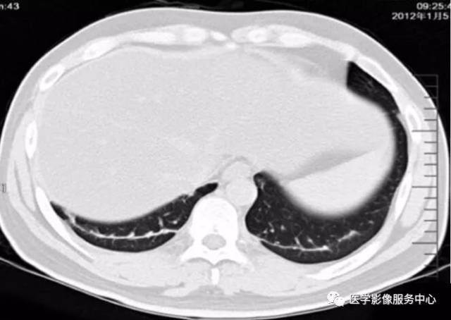 示双肺下叶条索状纤维化影 百草枯中毒患者预后的ct评估