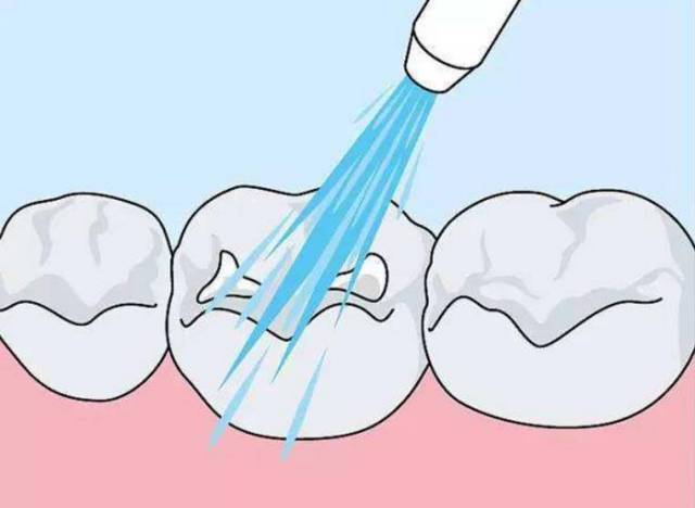 2,逐步把普通牙刷改为电动牙刷,以增强牙齿清洁的效果