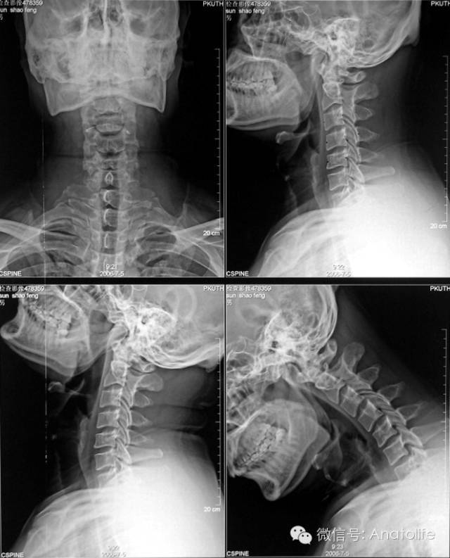 颈椎正侧位及屈伸片