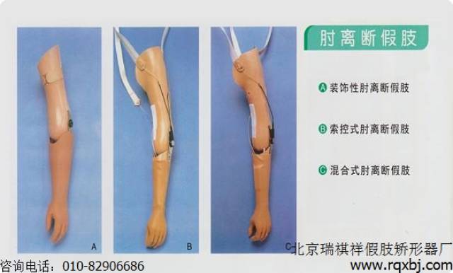 (四)肘离断假肢的选配