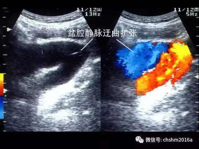 图14-3-3 盆腔瘀血静脉扩张声像