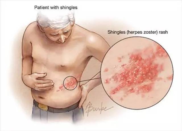 水痘痊愈就能终生免疫?