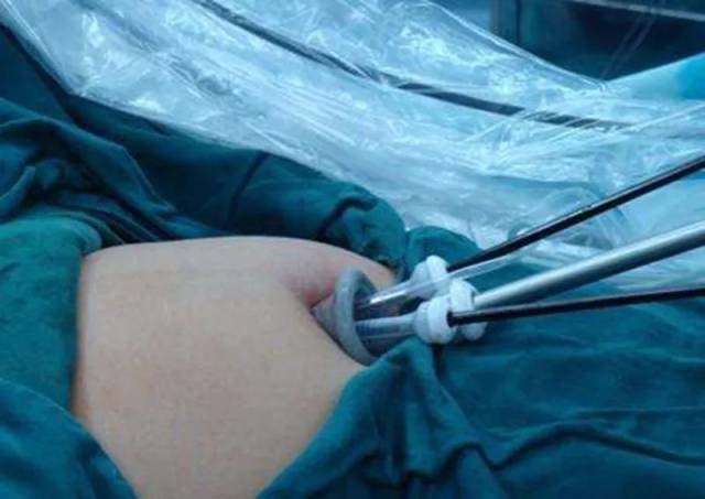 妇科李宗婷主任为周小姐采用 单孔腹腔镜手术探查,只通过肚脐这个自然