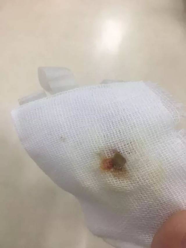 4 月 13 日,宝安中心医院确诊曾先生脐周肿胀是异物感染所致,医生怀疑